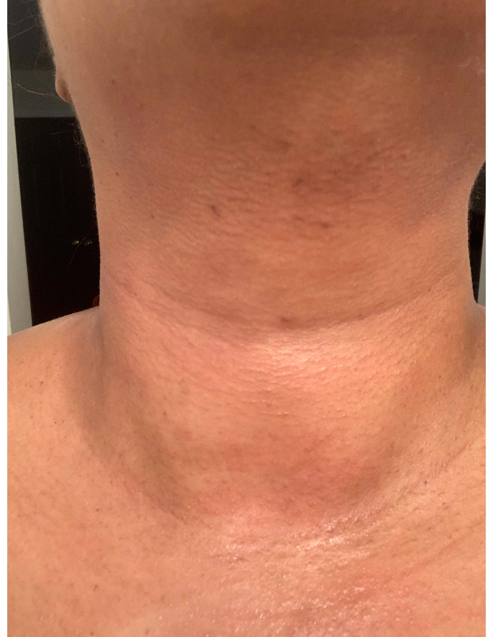 My neck during the breakout. Dark patches, itchy skin.